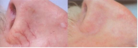 Mũi đỏ hay còn được gọi là mũi cà chua