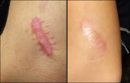 Những vết sẹo khiến chúng ta mất tự tin, ngại ngùng khi giao tiếp