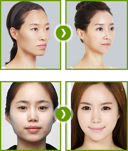 Phẫu thuật nâng gò má cao sẽ giúp bạn có gương mặt cá tính, sang trọng