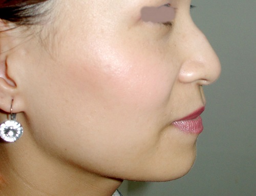 Mũi gồ có thể do bẩm sinh từ nhỏ