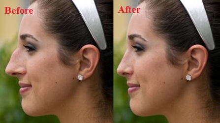 Nếu mũi gồ nhẹ chỉ cần nâng mũi là bạn đã có chiếc mũi như ý