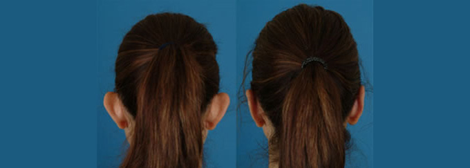 Tai vểnh khiến bạn trở nên kém tự tin với vẻ bên ngoài của mình