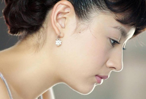 Sau sửa tai vểnh bạn sẽ có đôi tai như ý 