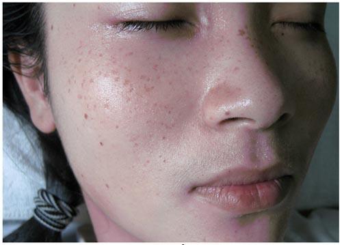 Đồi mồi là dấu hiệu đặc trưng của lão hóa