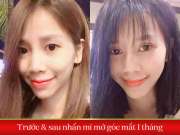 Sherry Lim: “nhấn mí mở góc mắt không đau, không sưng tím, không chảy máu…”