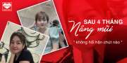 Sau nâng mũi 5 tháng, em không hối hận chút nào