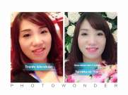  U40 nổi tiếng là cầu toàn, nói về nhấn mí sau 3 lần tư vấn tại 3 địa chỉ