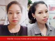  Chị gái độn cằm nâng mũi, em gái “tiếp bước” nâng mũi nhấn mí và cái kết…