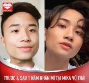  Mỹ nam đẹp hơn hoa “lột xác” sau 1 năm nhấn mí tại Mika Vũ Thái