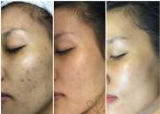  Phương pháp thay da vi kim tảo biển hiệu quả không? Review từ quy trình đến kết quả