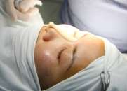  Nâng mũi bọc sụn nhân tạo