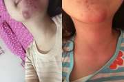  [Tin Nóng] Tiêm fiiler bị vón cục, sưng bầm tím có nguy hiểm không?