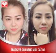 Bác nâng mũi cho em đẹp quá giờ đi đâu chồng em cũng kè kè theo