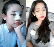  Nâng mũi bọc sụn giá bao nhiêu mà tình địch của Midu có thể thực hiện khi chưa đủ 16 tuổi.