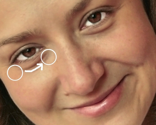 Phẫu thuật cắt da thừa mí mắt dưới Webtretho