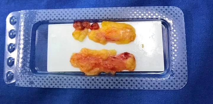 Lời chia sẻ và hình ảnh của khách hàng sau khi nhấn mí mắt và bóc mỡ mí mắt.