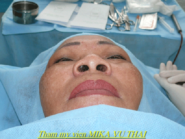 Trước khi phẫu thuật thu nhỏ đầu mũi
