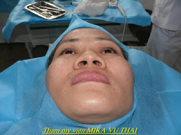Mọi người thường kết hợp nâng mũi và thu nhỏ đầu mũi