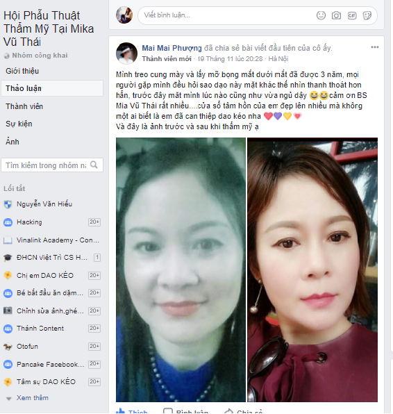 Treo chân mày ở đâu đẹp?